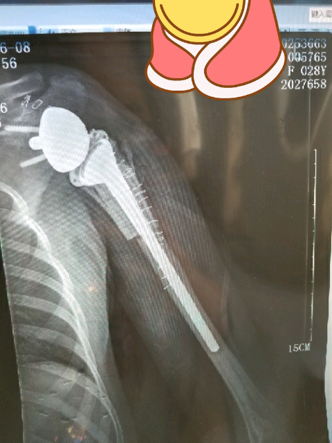 自1965首例报道到现在国内外也就百余例的骨癌