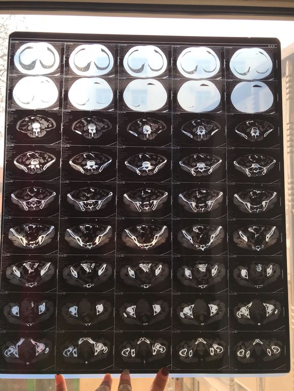 有子宫肉瘤的吗？