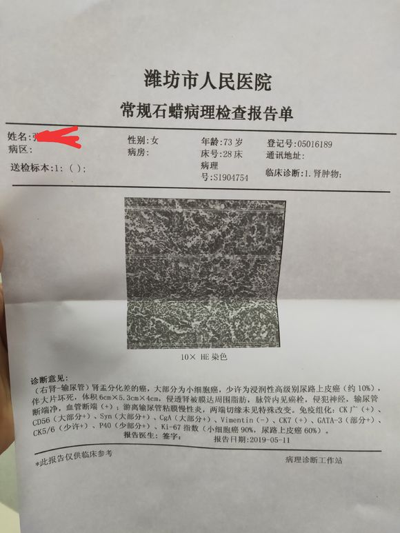 我妈确诊小细胞肾癌，现在已经做了右肾切除手术