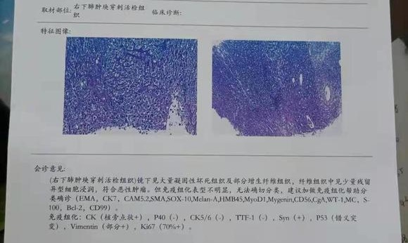 大细胞肺癌，患者70岁，有常年吸烟氏