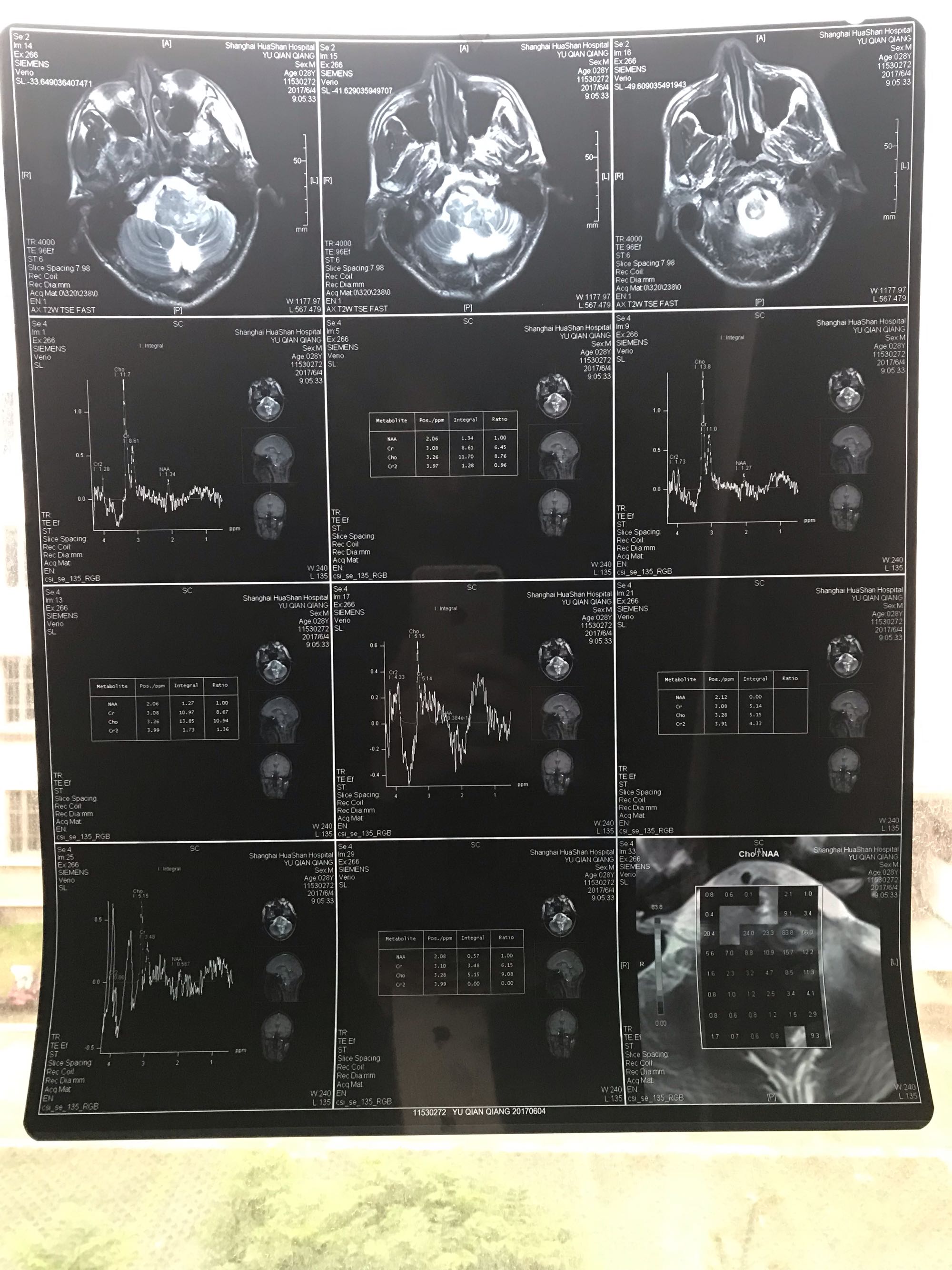 谁帮我看看肿瘤在哪里多大谢谢各位