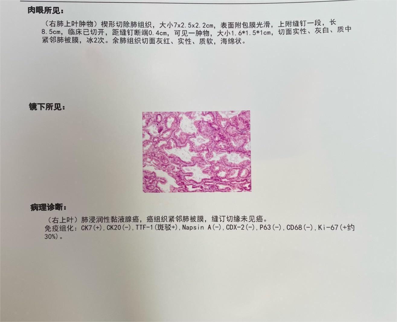 肺腺癌（粘液腺癌）1a2期无高危需要做基因检测吗