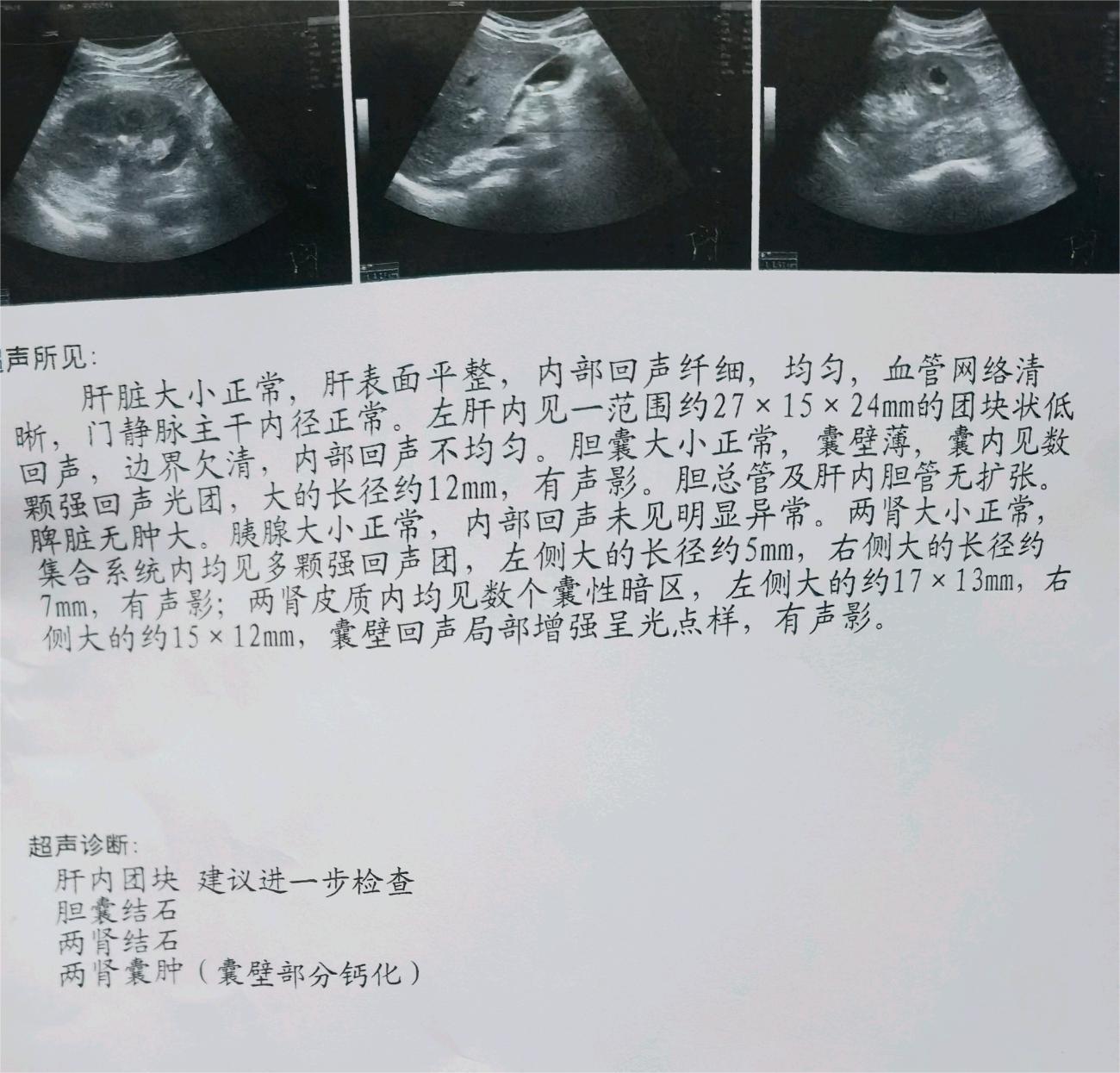 我这个是不是肝癌跑不了了，我才31岁啊