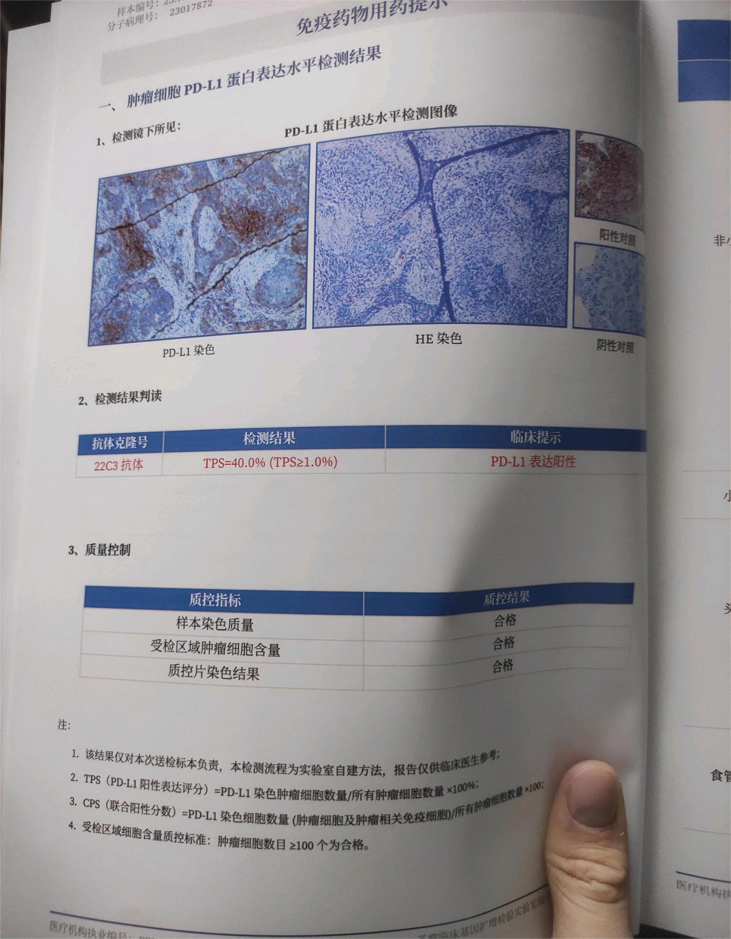 请问淋巴上皮瘤样癌很凶险吗，是属于大细胞癌么