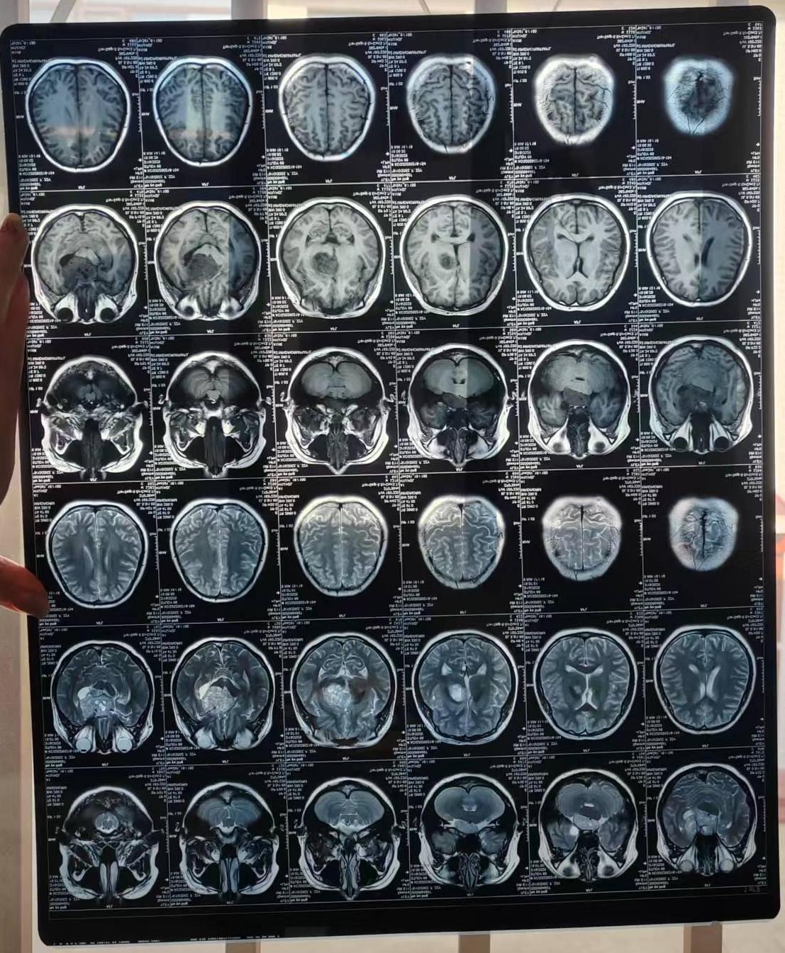 好像是脑瘤，怎么办